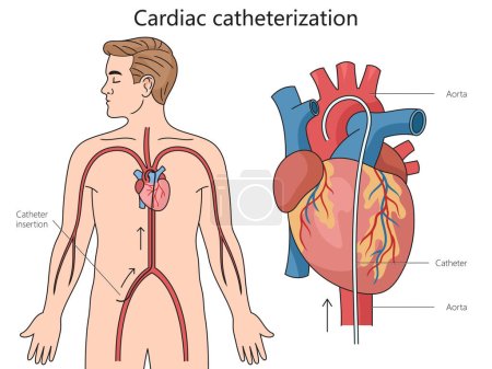 Diagrama de estructura de cateterismo cardíaco ilustración de trama esquemática dibujada a mano. Ilustración educativa de ciencias médicas