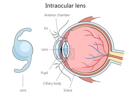Intraocular lens structure diagram hand drawn schematic raster illustration. Medical science educational illustration
