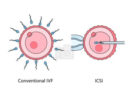 contrasting conventional In Vitro Fertilization IVF with Intracytoplasmic Sperm Injection ICSI technique hand drawn schematic raster illustration. Medical science educational illustration