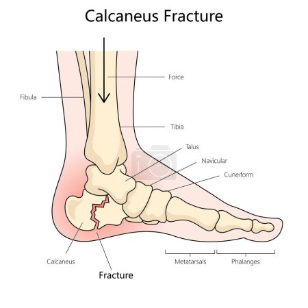Calcaneus fracture structure diagram hand drawn schematic raster illustration. Medical science educational illustration