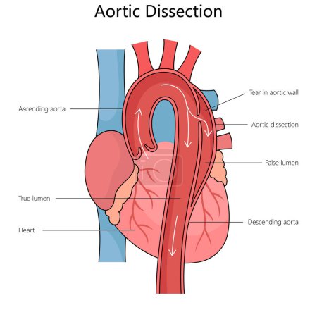Human aortic dissection, showing the true and false lumens and a tear in the aortic wall structure diagram hand drawn schematic raster illustration. Medical science educational illustration