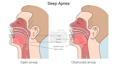 Photo for Sleep apnea structure diagram hand drawn schematic raster illustration. Medical science educational illustration - Royalty Free Image