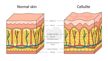 Schéma de structure de peau de cellulite humaine illustration schématique raster dessinée à la main. Illustration pédagogique en sciences médicales
