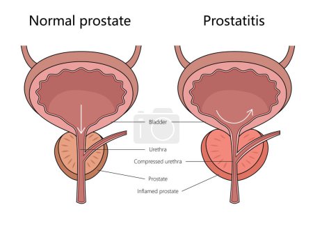 normal prostate and prostatitis, indicating inflammation and compression structure diagram hand drawn schematic raster illustration. Medical science educational illustration