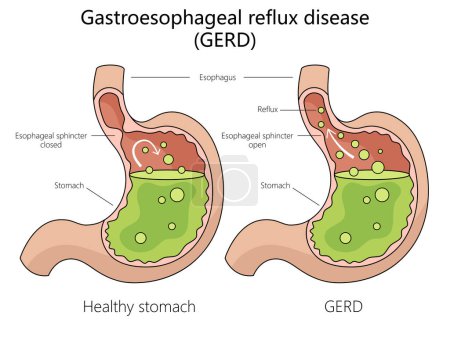 Photo for Human gastroesophageal reflux disease structure diagram hand drawn schematic raster illustration. Medical science educational illustration - Royalty Free Image