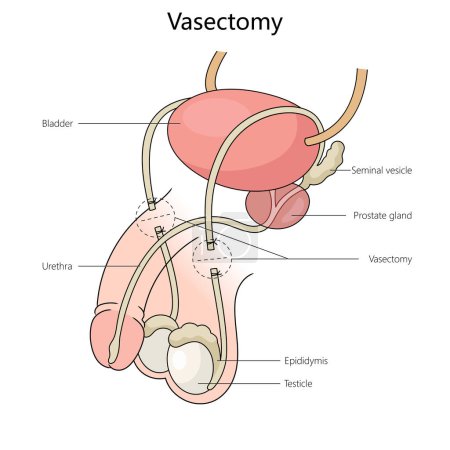 vasectomy on the male reproductive system, highlighting key anatomical features structure diagram hand drawn schematic raster illustration. Medical science educational illustration