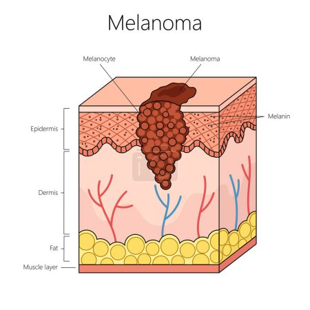 Melanom-Hautkrebs mit Schwerpunkt auf Melanozyten und Hautschichten, einschließlich des von Hand gezeichneten schematischen Rasterdiagramms der Epidermis und Dermis. Pädagogische Illustration der Medizinwissenschaften
