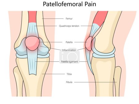 Diagrama de estructura del síndrome de dolor patelofemoral ilustración esquemática dibujada a mano. Ilustración educativa de ciencias médicas