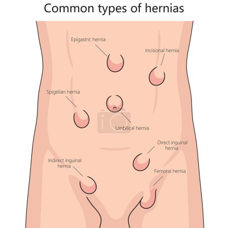 Human various hernia types on human abdomen for health and medical studies structure diagram hand drawn schematic raster illustration. Medical science educational illustration