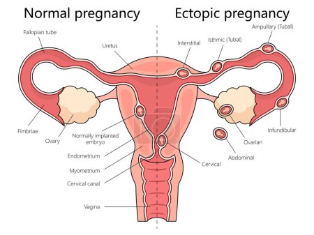 Human normal and ectopic pregnancies with labeled female reproductive system structure diagram hand drawn schematic raster illustration. Medical science educational illustration
