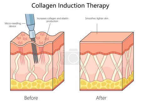 estructura de la piel antes y después de la terapia de inducción de colágeno utilizando un dispositivo de microagujas para mejorar la ilustración esquemática del diagrama de textura de la piel. Ilustración educativa de ciencias médicas