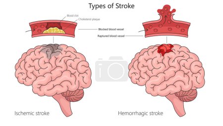 Human ischemic stroke and hemorrhagic stroke in human brain anatomy structure diagram hand drawn schematic raster illustration. Medical science educational illustration