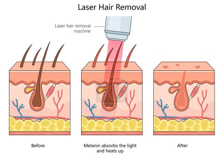 Laser-Haarentfernung, die die Haut vor, während und nach dem Eingriff zeigt. Handgezeichnete schematische Rasterdarstellung. Pädagogische Illustration der Medizinwissenschaften