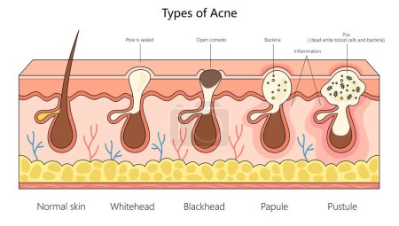 Photo for Various acne types, from normal skin to inflamed pustules, for dermatological studies structure diagram hand drawn schematic raster illustration. Medical science educational illustration - Royalty Free Image