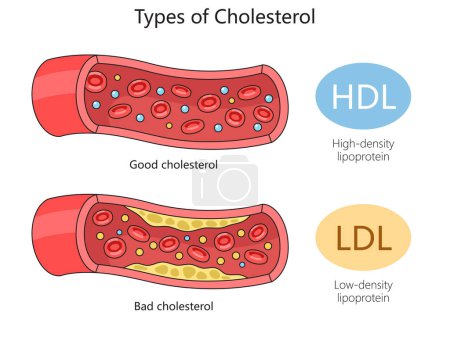 HDL good cholesterol and LDL bad cholesterol in blood vessels for health education diagram hand drawn schematic raster illustration. Medical science educational illustration