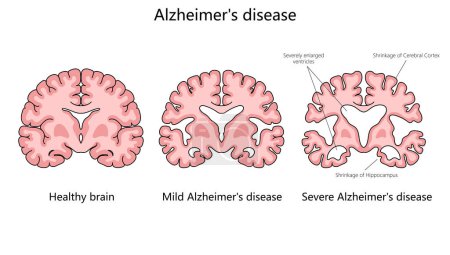 Fortschreiten der Alzheimer-Krankheit, indem man ein gesundes Gehirn mit solchen mit mildem und schwerem Alzheimer-Strukturdiagramm vergleicht, das eine schematische Rasterdarstellung darstellt. Pädagogische Illustration der Medizinwissenschaften