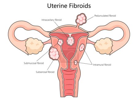 Varios tipos humanos de fibromas uterinos, incluyendo submucosos, subserosos e intramurales diagrama de estructura de fibromas ilustración esquemática dibujada a mano. Ilustración educativa de ciencias médicas