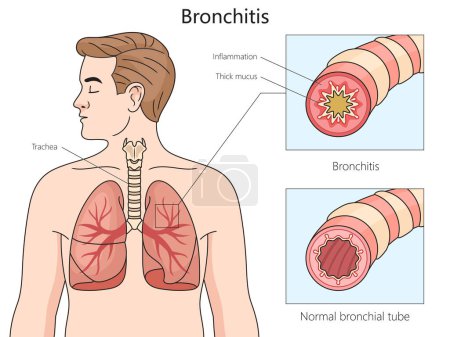 Gesunde und Bronchitis befallene Bronchien, mit einem Schwerpunkt auf Entzündungen und Schleimbildung Struktur Diagramm handgezeichnete schematische Rasterdarstellung. Pädagogische Illustration der Medizinwissenschaften