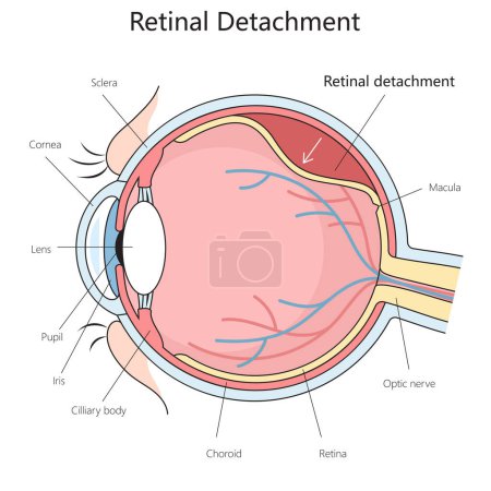 anatomía del ojo humano que muestra desprendimiento de retina, incluyendo la córnea, lente, y la estructura del nervio óptico diagrama dibujado a mano ilustración trama esquemática. Ilustración educativa de ciencias médicas