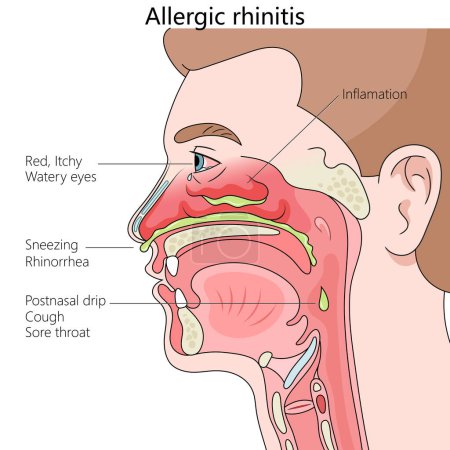 Allergic rhinitis, showing symptoms like sneezing, watery eyes, and inflammation diagram hand drawn schematic raster illustration. Medical science educational illustration