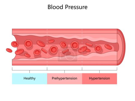 blood pressure levels, showing healthy, prehypertension and hypertension stages within blood vessel structure diagram hand drawn schematic raster illustration. Medical science educational illustration