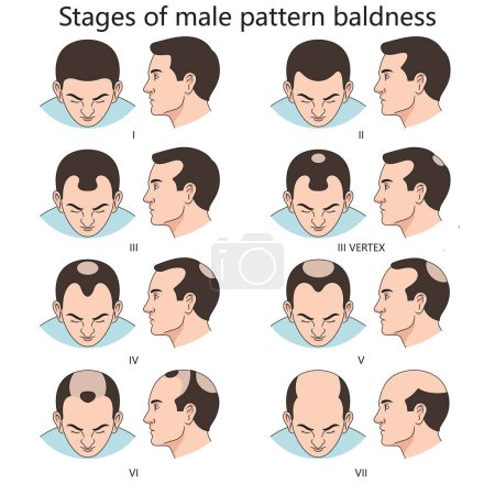 Stages of male pattern baldness, showing progressive hair loss from stage I to stage VII diagram hand drawn schematic raster illustration. Medical science educational illustration