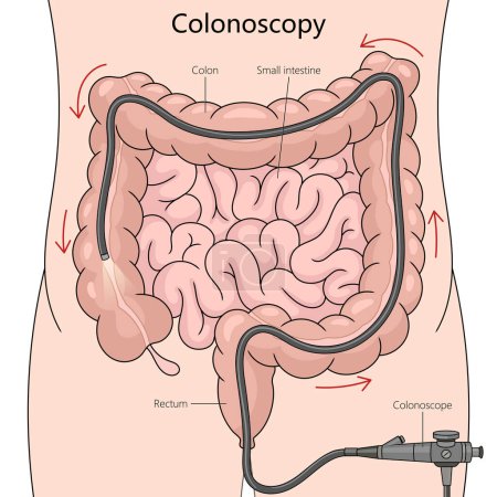 procedimiento de colonoscopia, detallando la trayectoria del colonoscopio a través del colon y el diagrama de intestino delgado ilustración de trama esquemática dibujada a mano. Ilustración educativa de ciencias médicas