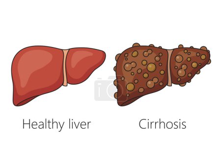 Illustration for Healthy liver and liver with cirrhosis disease schematic vector illustration. Medical science educational illustration - Royalty Free Image