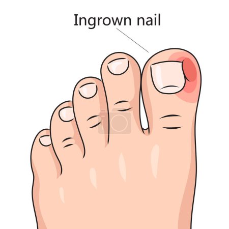 Ingrown nail onychocryptosis diagram schematic vector illustration. Medical science educational illustration