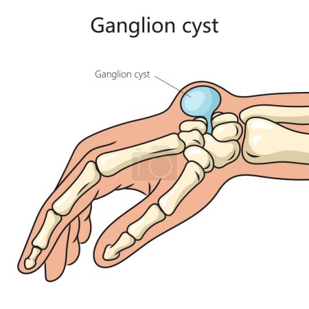 Illustration for Ganglion cyst structure disease diagram schematic vector illustration. Medical science educational illustration - Royalty Free Image