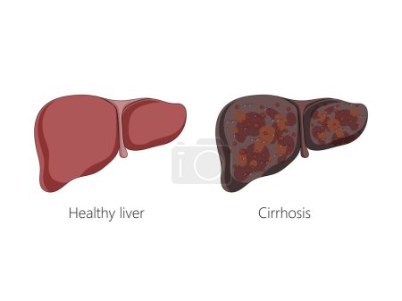 Illustration for Healthy liver and liver with cirrhosis disease schematic vector illustration. Medical science educational illustration - Royalty Free Image