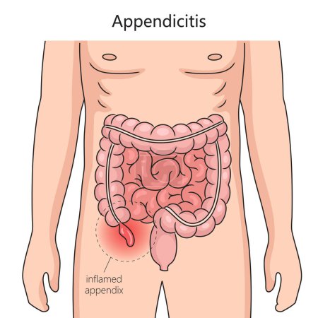 Illustration for Appendicitis inflammation of the appendix diagram schematic vector illustration. Medical science educational illustration - Royalty Free Image