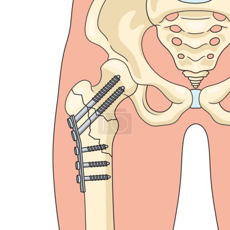 Ilustración de Operación de fijación interna en ortopedia quirúrgica reparación del diagrama óseo ilustración esquemática vectorial. Ilustración educativa de ciencias médicas - Imagen libre de derechos