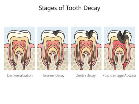 Ilustración de Caries caries dental etapas diagrama esquema vector ilustración. Ilustración educativa de ciencias médicas - Imagen libre de derechos