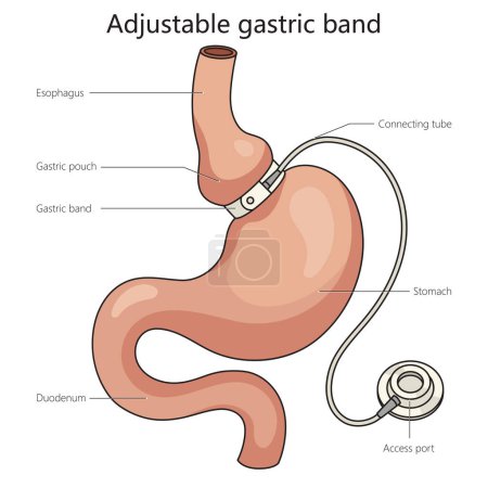 Adjustable gastric band stomach band structure diagram schematic vector illustration. Medical science educational illustration
