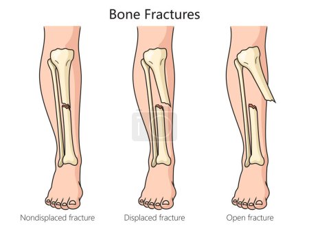 Arten von Knochenbrüchen zeigen schematische Vektordarstellungen. Pädagogische Illustration der Medizinwissenschaften