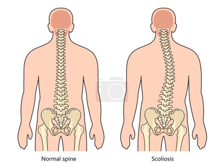 Illustration for Scoliosis structure scheme diagram schematic vector illustration. Medical science educational illustration - Royalty Free Image