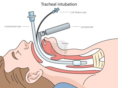 Schéma de structure d'intubation trachéale illustration vectorielle schématique dessinée à la main. Illustration pédagogique en sciences médicales