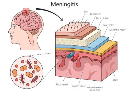 Illustration for Meningitis disease diagram hand drawn schematic vector illustration. Medical science educational illustration - Royalty Free Image