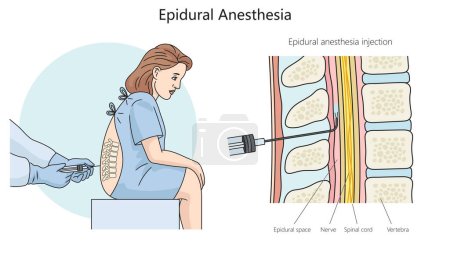Illustration for Epidural anesthesia diagram hand drawn schematic vector illustration. Medical science educational illustration - Royalty Free Image