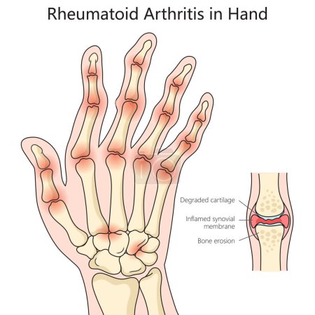 Ilustración de Artritis reumatoide humana del diagrama de la estructura de la mano ilustración esquemática dibujada a mano del vector. Ilustración educativa de ciencias médicas - Imagen libre de derechos