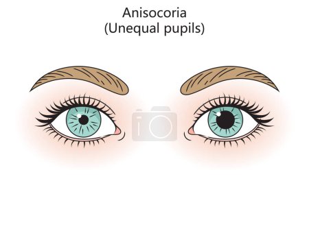 Human eyes with anisocoria diagram hand drawn schematic vector illustration. Medical science educational illustration