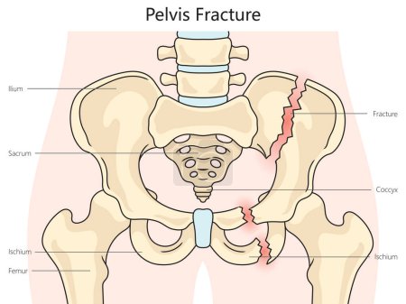Pelvic pelvis fracture structure diagram hand drawn schematic vector illustration. Medical science educational illustration