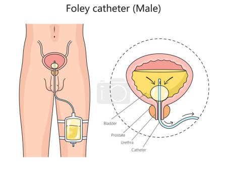 Diagrama de estructura del catéter urinario foley masculino ilustración esquemática dibujada a mano del vector. Ilustración educativa de ciencias médicas