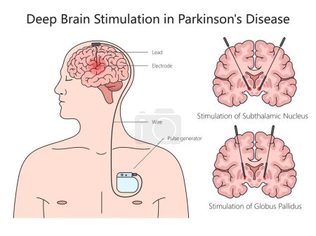 Ilustración de Estructura de estimulación cerebral profunda Diagrama de la enfermedad de Parkinson ilustración esquemática dibujada a mano del vector. Ilustración educativa de ciencias médicas - Imagen libre de derechos