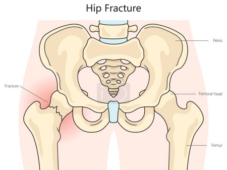 Illustration for Hip fracture structure diagram hand drawn schematic vector illustration. Medical science educational illustration - Royalty Free Image