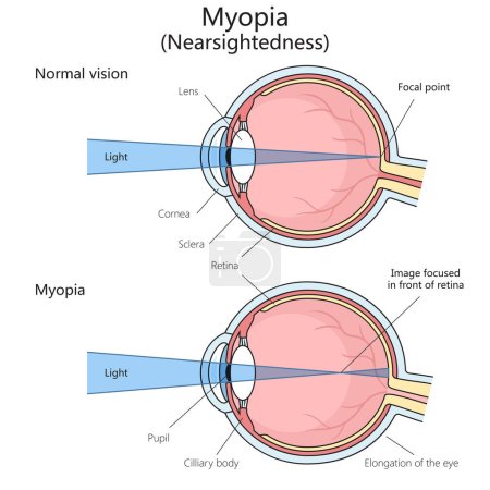 Myopia disorder of vision structure diagram hand drawn schematic vector illustration. Medical science educational illustration