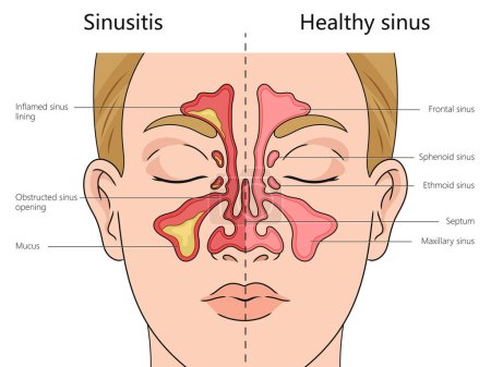 Sinusitis Strukturdiagramm handgezeichnete schematische Vektorillustration. Pädagogische Illustration der Medizinwissenschaften