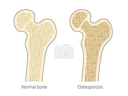 Téléchargez les illustrations : Structure osseuse humaine avec diagramme d'ostéoporose illustration vectorielle schématique dessinée à la main. Illustration pédagogique en sciences médicales - en licence libre de droit