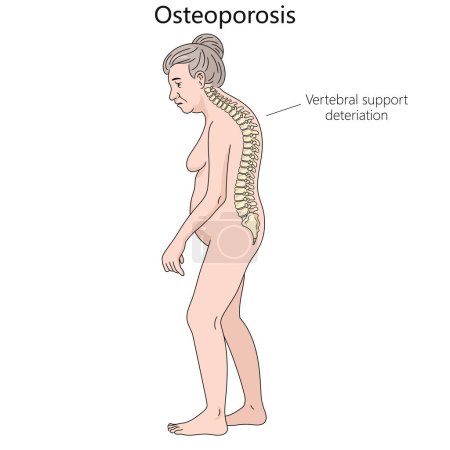 osteoporosis humana postura deterioro vertebral columna vertebral diagrama mano dibujado ilustración vectorial esquemática. Ilustración educativa de ciencias médicas